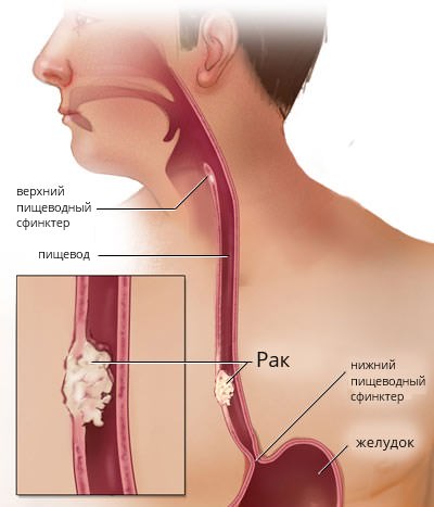 the presence of the esophageal tracheal esophageal bronchial fistula Наличие пищеводно-трахеального, пищеводно-бронхиального свища
