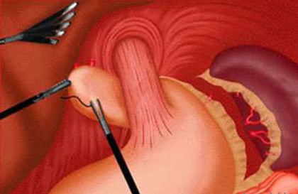 the stages of operation of the esophagus Этапы операции пищевода