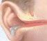 inflammatory diseases of the middle ear Воспалительные заболевания среднего уха