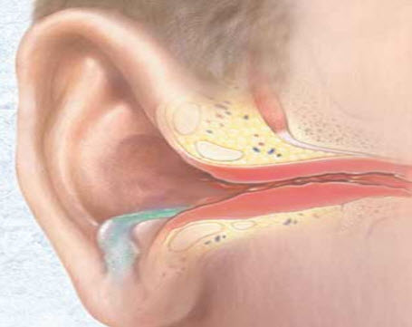 inflammatory diseases of the middle ear Воспалительные заболевания среднего уха
