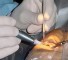 microsurgery tumors Микрохирургия удаления опухолей