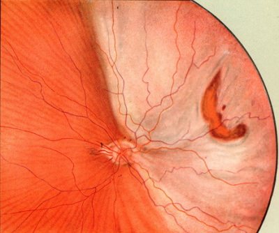 retinal detachment Отслойка сетчатки