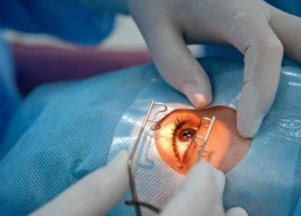 surgery on the eyes Операция на глазах