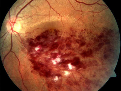 swelling of the retina in the macular area Отек сетчатки в макулярной области