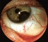 the development of eye tumors Развитие глазных опухолей
