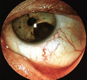 the development of eye tumors Развитие глазных опухолей