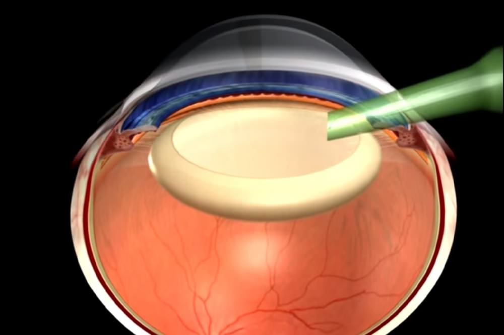 the transparency of a cataractous lens Прозрачность помутневшего хрусталика