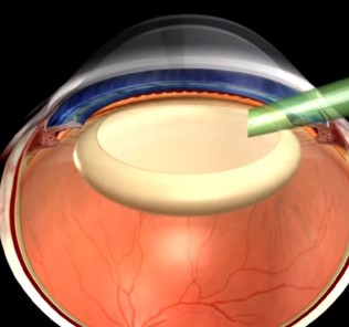 the transparency of a cataractous lens Прозрачность помутневшего хрусталика