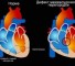 atresia of the pulmonary artery in combination with ventricular septal defect Атрезия легочной артерии в сочетании с дефектом межжелудочковой перегородки
