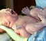 coarctation of aorta in infants Коарктация аорты у детей грудного возраста