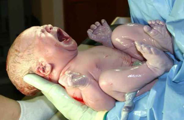 coarctation of aorta in infants Коарктация аорты у детей грудного возраста