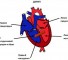 coarctation of the aorta in combination with ventricular septal defect Коарктация аорты в сочетании с дефектом межжелудочковой перегородки
