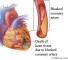 isolation of the coronary arteries Изолирование корональных артерий