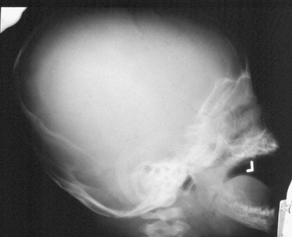 lacunar skull Лакунарный череп