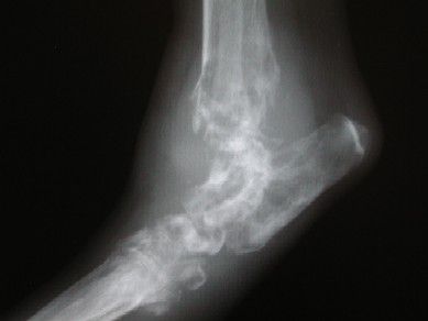 osteosarcoma Остеосаркома