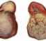 other tumors of the kidney Другие опухоли почек
