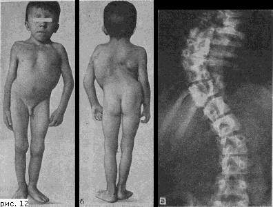 pathology of the spine Патологии позвоночника