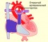 persistent ductus arteriosus Открытый артериальный проток