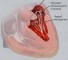 prolapse of the left atrioventricular valve Пролапс левого предсердно-желудочкового клапана