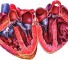 transposition of the great arteries in combination with stenosis of the pulmonary artery Транспозиция магистральных сосудов в сочетании со стенозом легочной артерии