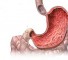 tumors of the gastrointestinal tract Опухоли желудочно-кишечного тракта