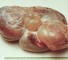 tumors of the gonads and germinoma Опухоли половых желез и герминомы