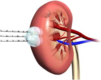 tumors of the kidney Опухоли почек