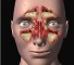 acquired deformities of the facial skull Приобретенные деформации лицевого черепа