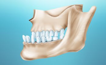 anterior displacement of the mandible Мезиальное смещение нижней челюсти
