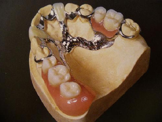combined prosthesis in the oral cavity Установка комбинированного протеза в полости рта