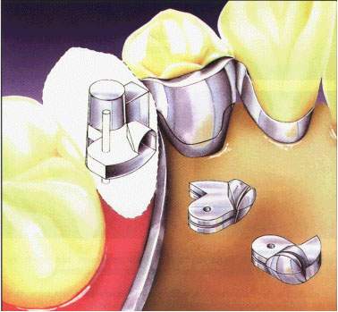 compatibility of dental arches in the transverse plane Совместимость зубных дуг в трансверзальной плоскости