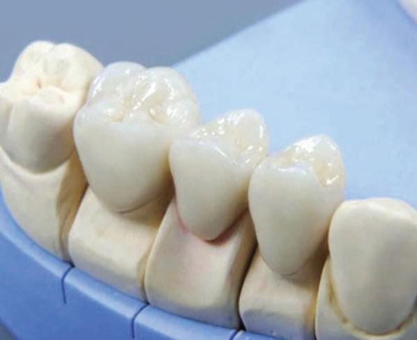diagnostic impression the choice of the abutment teeth and dissection Диагностический оттиск, выбор опорных зубов и препарирование