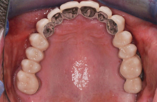 dual crowns without frictions Двойные коронки без фрикции