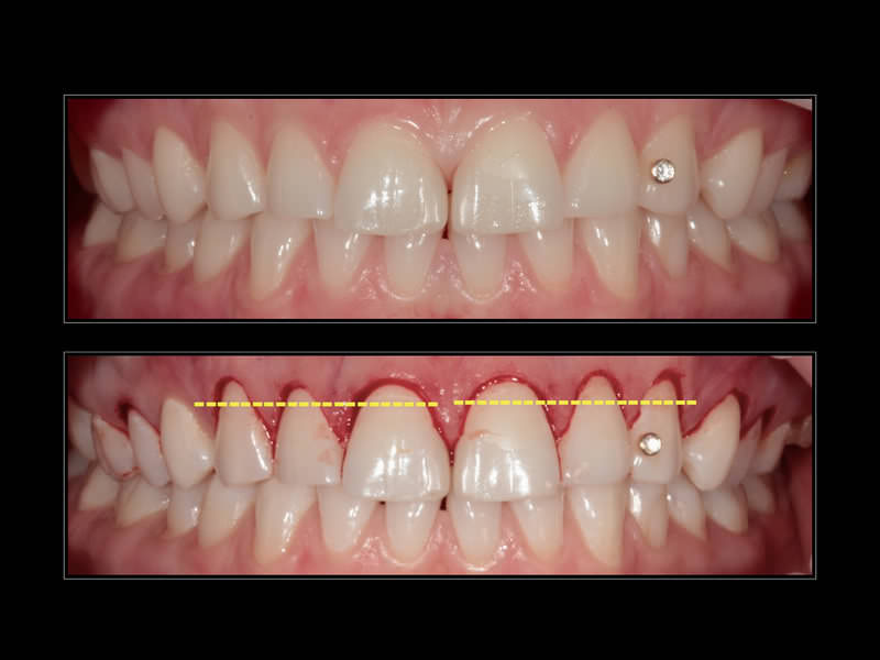 Удлиненные зубы