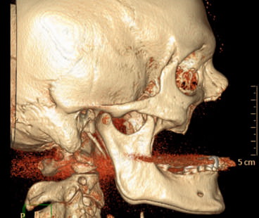 facial skull deformed Лицевой череп деформирован
