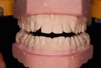 skeletal forms in the third class the ratio of teeth on anglo Скелетные формы при III классе соотношения зубных рядов по Энглю