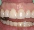 surgical stage of orthodontic treatment Постхирургический этап ортодонтического лечения