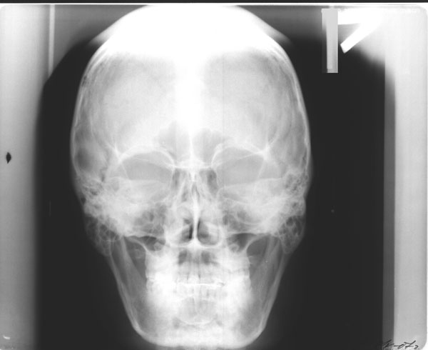 teleroentgenograms skull in lateral and in direct projections Телерентгенограммы черепа в боковой и в прямой проекциях