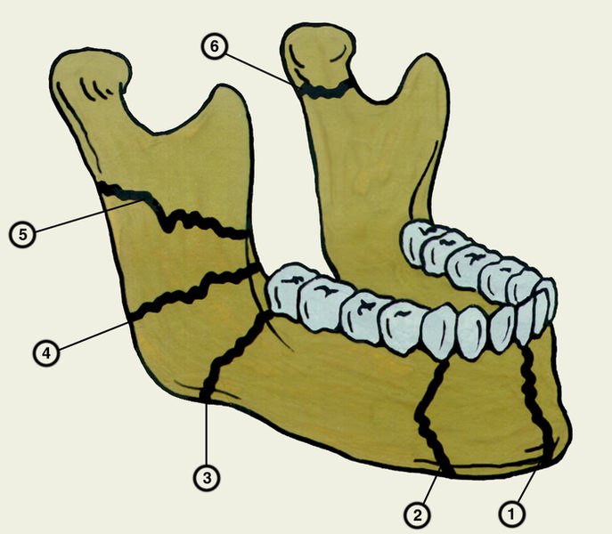 the body and the branches of the lower jaw Тело и ветви нижней челюсти