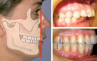 the clinical picture distal position of the lower jaw Клиническая картина дистального положения нижней челюсти