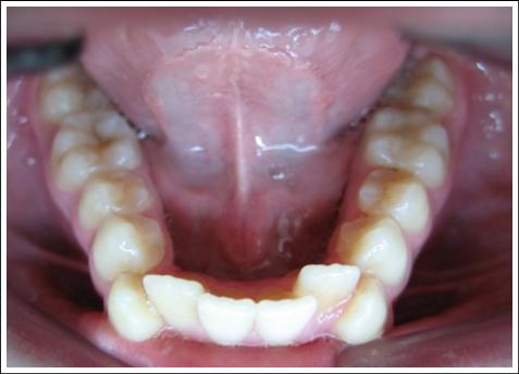 the degree of narrowing of dentition Степень сужения зубных рядов
