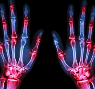 radiography fingers Рентгенография пальцев кисти