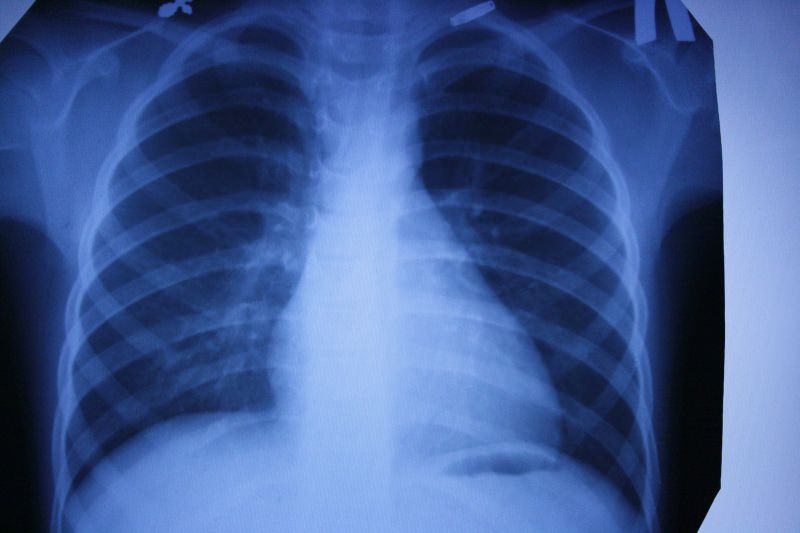 survey radiography of the chest Обзорная рентгенография грудной клетки