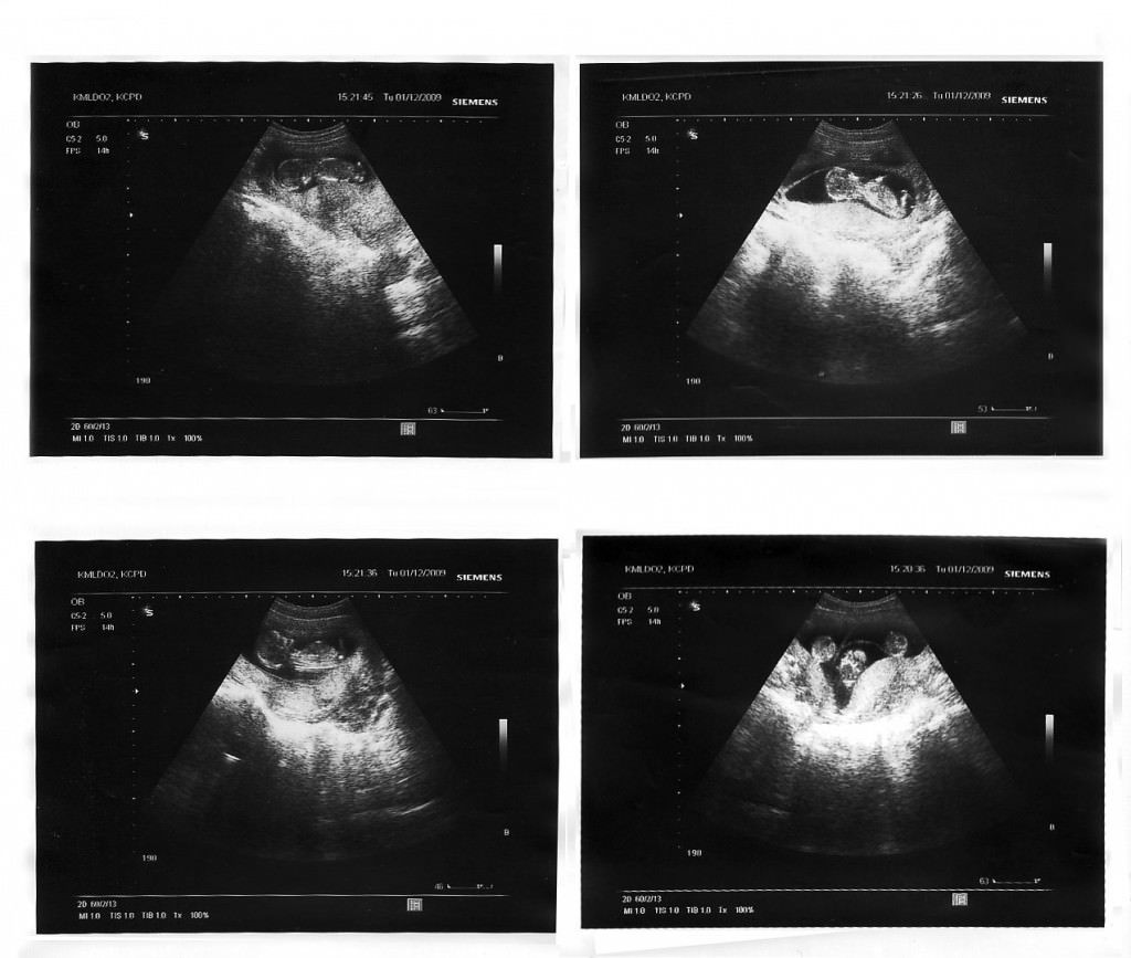 Ультразвуковая диагностика при многоплодной беременности