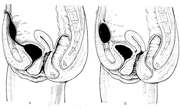 anomalies of the bladder Аномалии мочевого пузыря