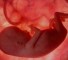 congenital single kidney and double kidney Врожденная единственная почка и удвоенная почка
