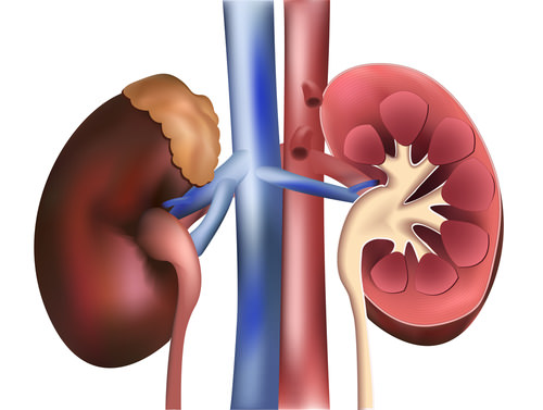 hypoplasia of kidneys Гипоплазия почки