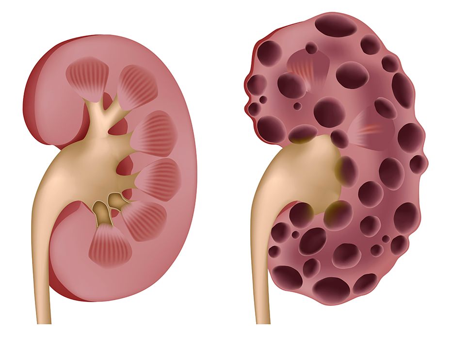 polycystic kidney disease Поликистоз почек