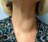 nodular thyroid gland Узловые образования щитовидной железы