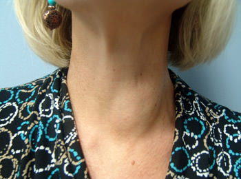 nodular thyroid gland Узловые образования щитовидной железы